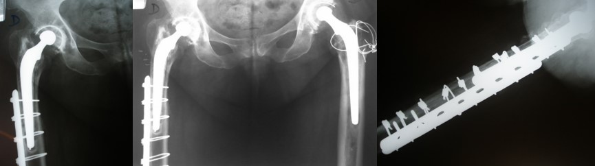 Radiografías de fractura periprotésica de cadera