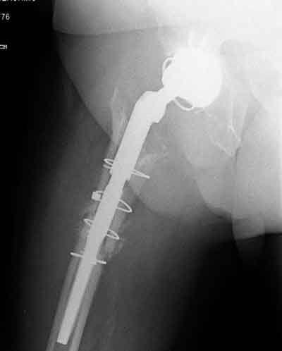 Recambio de prótesis de cadera por fractura periprotésica