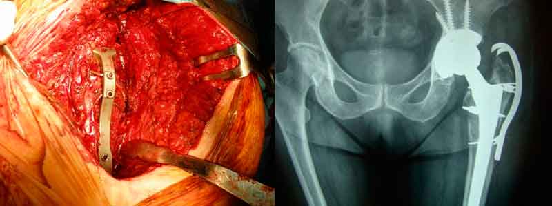 factores de riesgo asociados a las fracturas de cadera periprotésicas