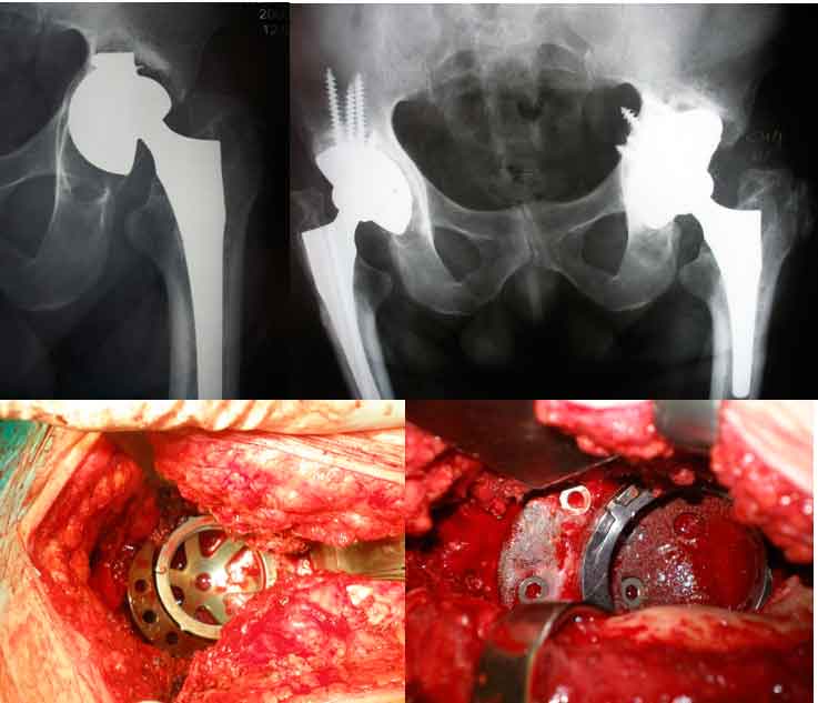 Aflojamiento de prótesis de cadera por Grave defecto acetabular.