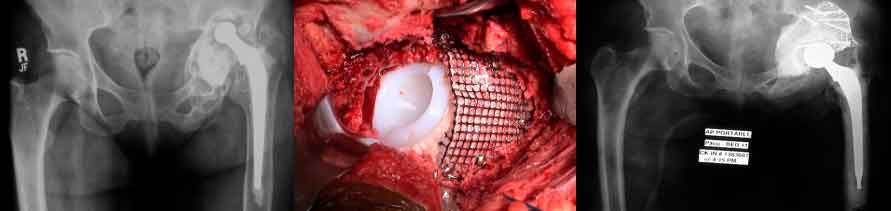Defecto masivo acetabular y aflojamiento de las prótesis de cadera