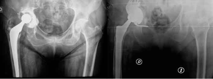 Revisión por aflojamiento de prótesis de cadera con vástago de Wagner y Cotilo Tantalio más un dispositivo antiprotrusión Cupcage