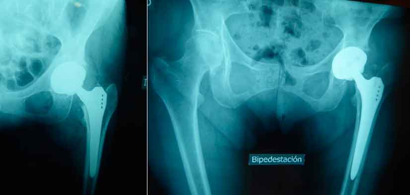 Síntomas del aflojamiento de prótesis de cadera: Hundimiento de vástago femoral. Este es un aflojamiento que suele suceder en los primeros meses de implantada la prótesis