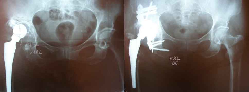 recambiar total o parcialmente una prótesis de cadera