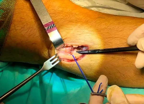 Descompresión del nervio ciático poplíteo externo en la rodilla