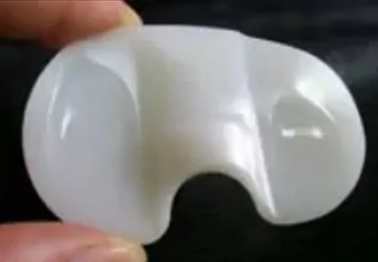 Desgaste del polietileno. Nótese la usura de los dos platillos o superficies del mismo