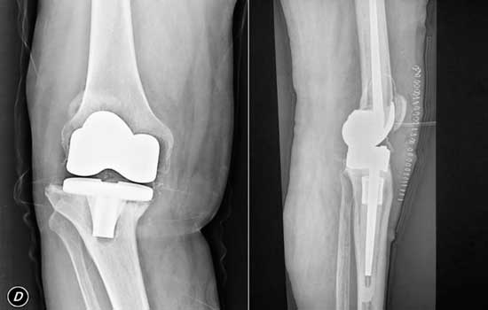 Radiografía de paciente con Recambio de prótesis de rodilla con Reconstrucción con prótesis de bisagra rotacional
