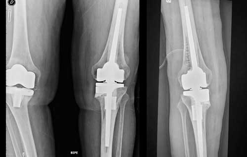 Revisión y recambio de prótesis de rodilla para evitar nuevos fracasos