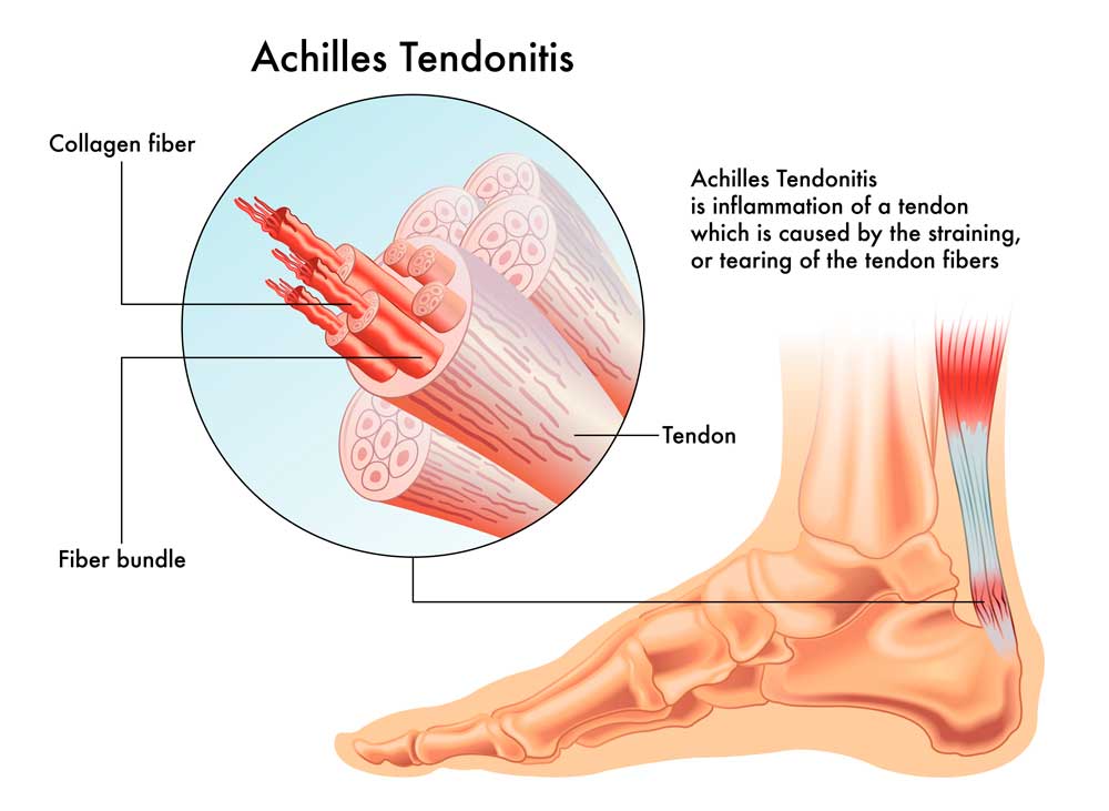 Tendinitis Aquilea, Tendinosis Aquilea Imagen de la anatomía del tendón de Aquiles Dr. Villanueva