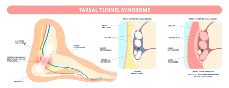 Síndrome del Túnel del Tarso
