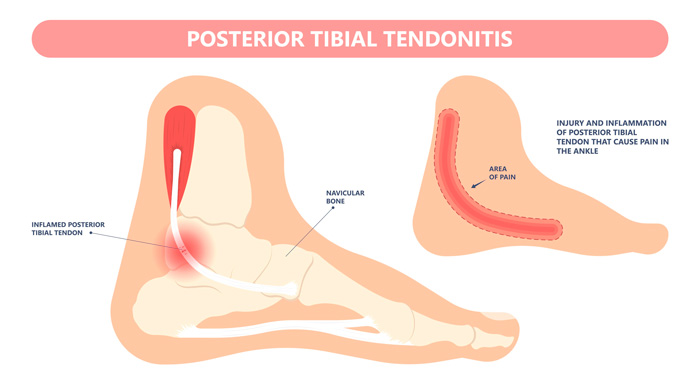 Tendinitis del tendón tibial posterior