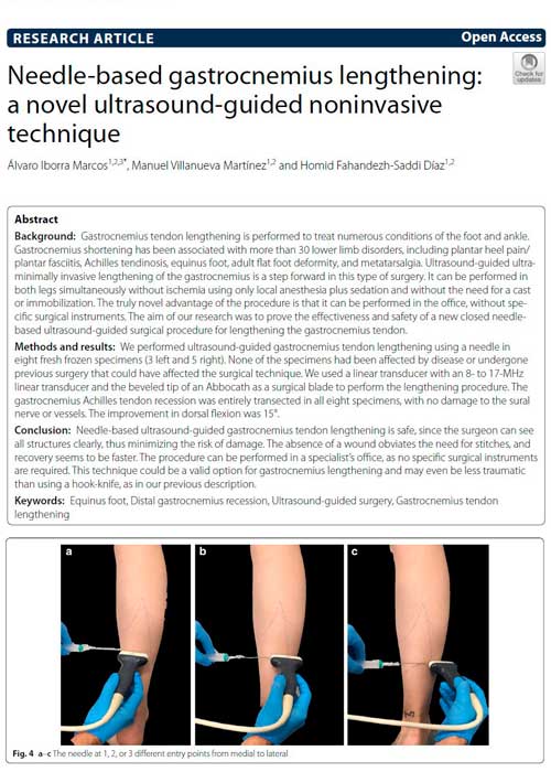 Needle-based gastrocnemius lengthening: a novel ultrasound-guided noninvasive technique