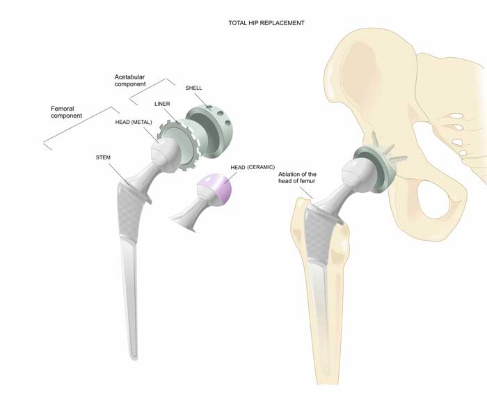 Aflojamiento protésico de cadera explicado por el Dr. Villanueva, especialista en casos complejos de cirugía de cadera