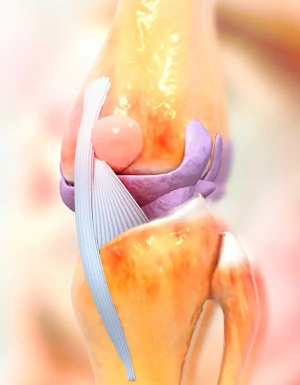Reemplazo de prótesis de rodilla no infectada