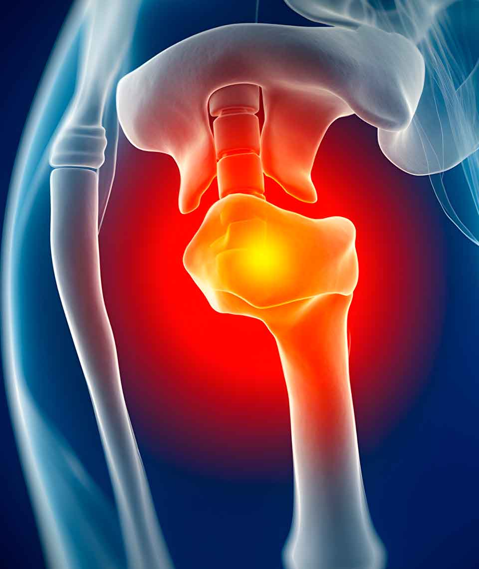 Infección protésica de cadera. Artículos del Dr. Villanueva. Especialista en casos complejos e infección de prótesis de cadera en Madrid.