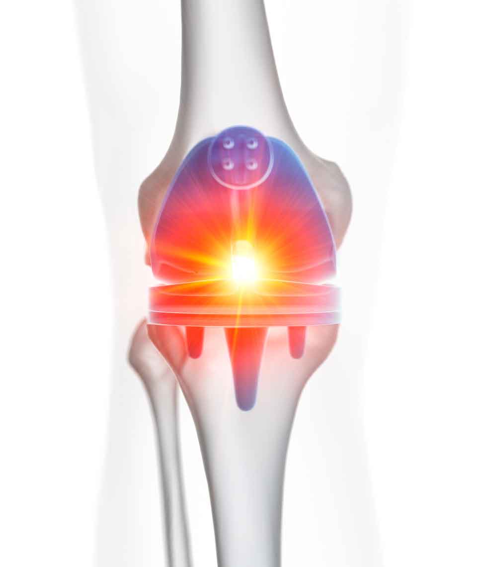 Cirugía por Infección de Prótesis de Rodilla