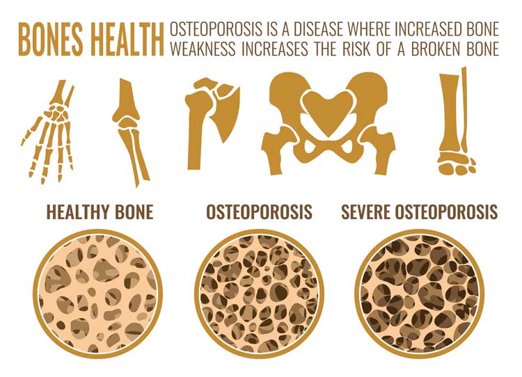 Dónde afecta la osteoporosis