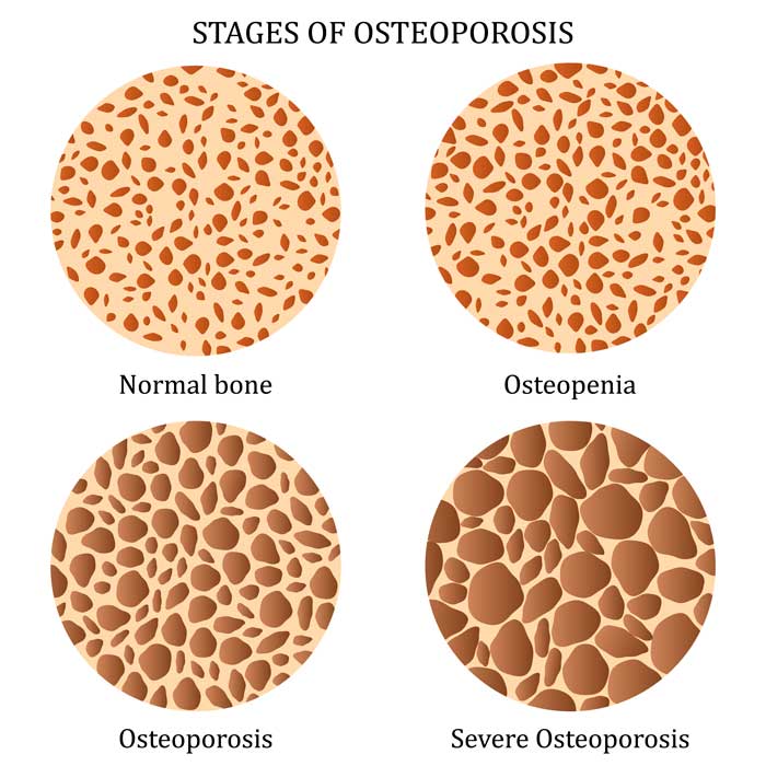 Estapas de la Osteoporosis por el Dr. Villanueva