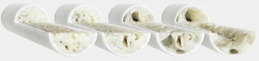 grados de osteoporosis grados de osteoporosis