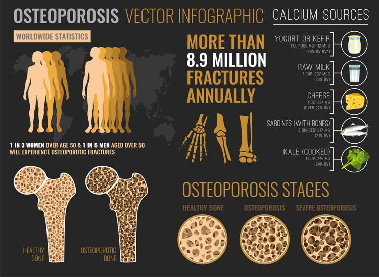 prevalencia de la osteoporosis