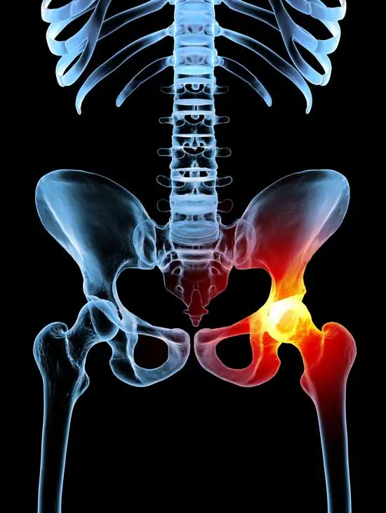 Todo lo que debes saber sobre la cirugía de revisión y recambio de la prótesis de cadera primaria de la mano del especialista en cirugía protésica de cadera Dr. Villanueva