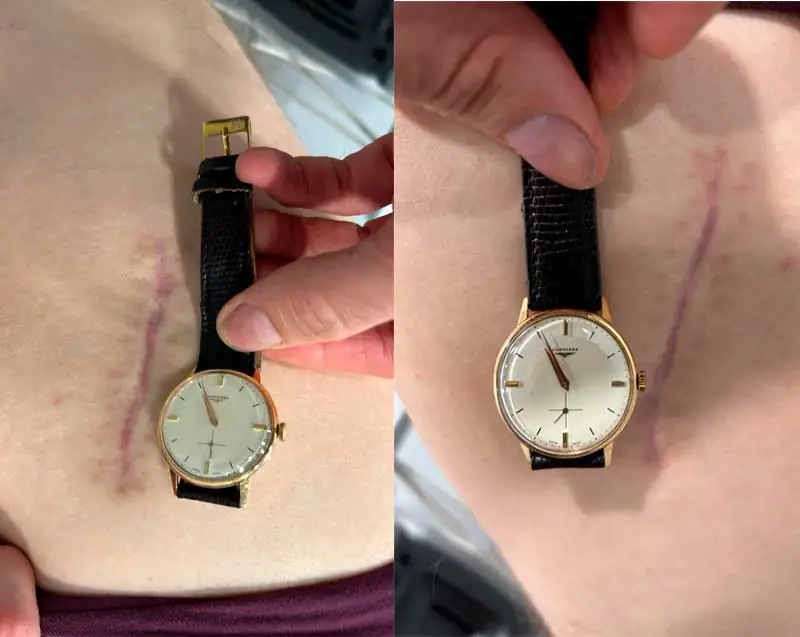 Cirugía mínimamente invasiva de prótesis de cadera y el reloj de mi abuelo el médico, siempre una firme referencia Cirugía mínimamente invasiva de prótesis de cadera y el reloj de mi abuelo el médico, siempre una firme referencia