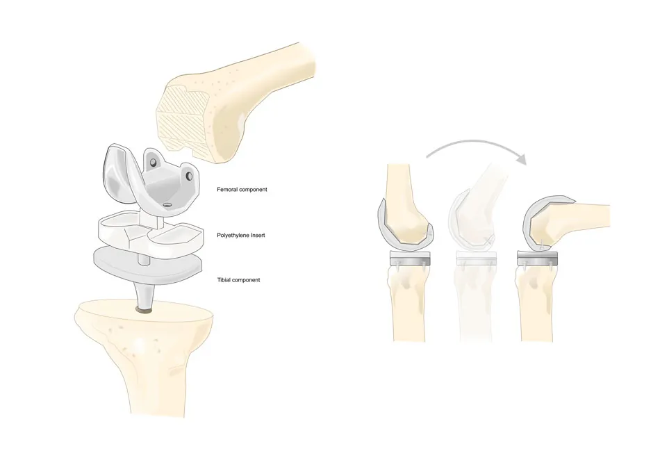 operación de prótesis de rodilla. Componentes de la articulación de la rodilla y de la prótesis
