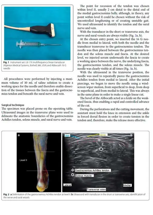 Alargamiento de gemelos-con una aguja Needle based gastrocnemius lengthening Alargamiento de gemelos-con una aguja Needle based gastrocnemius lengthening