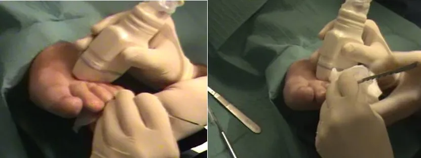 Cirugía ecoguiada del neuroma de Morton, sin isquemia, sin puntos