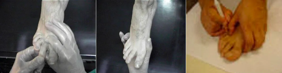 Diagnosticar el neuroma de Morton o heloma interdigital plantar. Exploración física