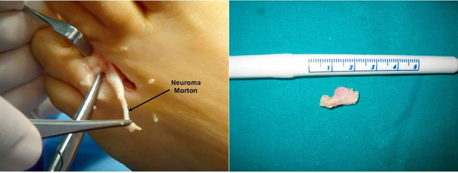 Imágen quirúrgica de la exéresis de neuroma de Morton por cirugía convencional