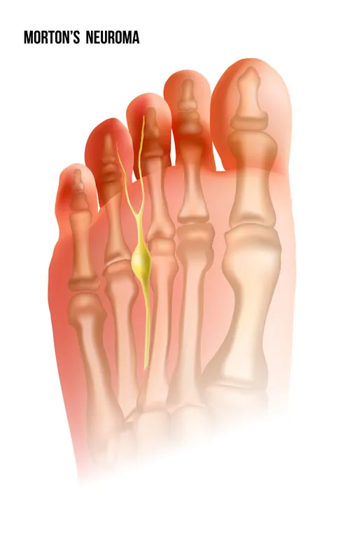 Localización del neuroma de Morton