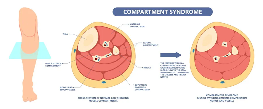 Síndrome compartimental agudo, crónico, de esfuerzo e isquémico. Anatomía de los compartimentos Síndrome compartimental agudo, crónico, de esfuerzo e isquémico. Anatomía de los compartimentos