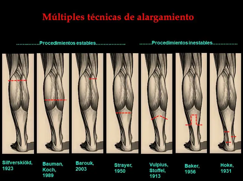 Técnicas quirúrgicas para el alargamiento de gemelos Técnicas quirúrgicas para el alargamiento de gemelos