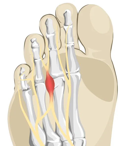 Tratar el neuroma de Morton o heloma interdigital plantar. Resolvemos tus dudas e inquietudes sobre la cirugía de esta neuropatía