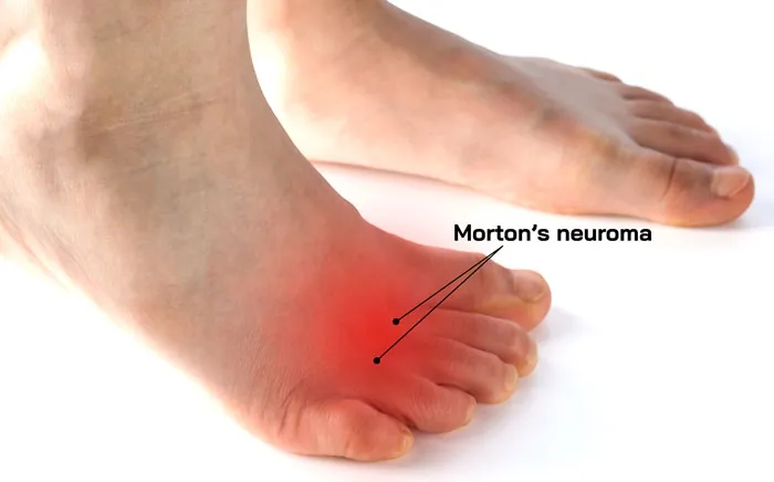 Ubicación del dolor en el holoma interdigital de los dedos de los pies