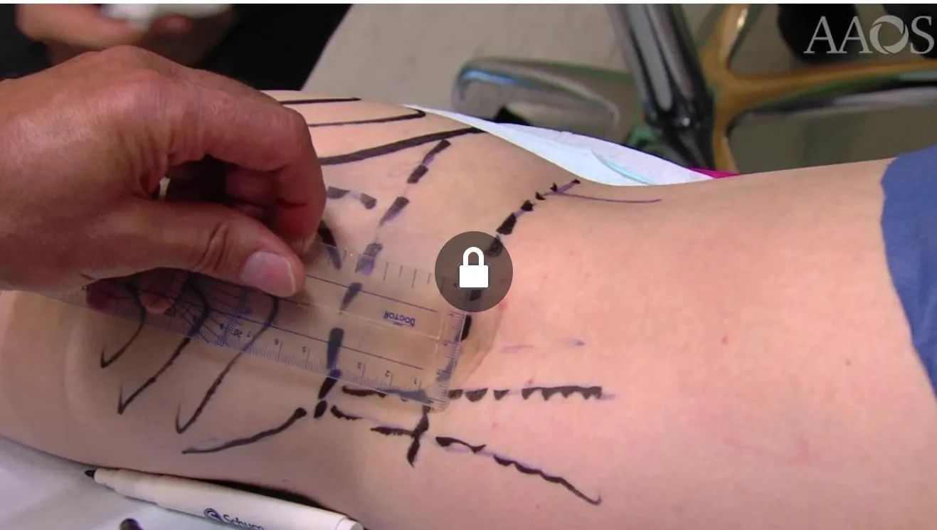Ultrasound-Guided Gastrocnemious Lengthening Ultraminimally Invasive Pathways