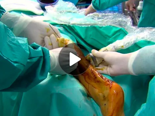 Ultrasound Guided Gastrocnemius Lengthening