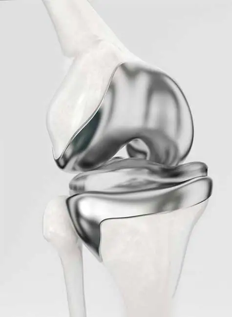 cirugía primaria de prótesis de rodilla cirugía primaria de prótesis de rodilla