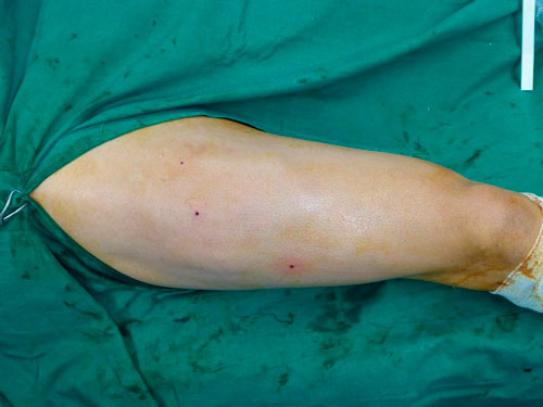 Cirugía ecoguiada del cuádriceps en futbolista profesional con secuelas de múltiples roturas musculares con cicatrices fibrosas Cirugía ecoguiada del cuádriceps en futbolista profesional con síndrome compartimental. Tenía secuelas de múltiples roturas musculares con cicatrices fibrosas que provocaban dolor y limitación al paciente