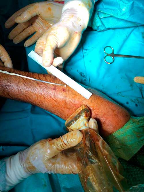 Descompresión ecoguiada del compartimento posterior de la pierna con dos incisiones de 1 mm. Descompresión ecoguiada del compartimento posterior de la pierna con dos incisiones de 1 mm. Los trayectos proximal y distal de la fasciotomía han de cruzarse para evitar dejar un puente de fascia sin cortar.