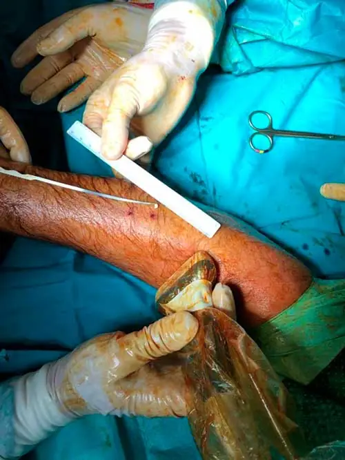 Descompresión ecoguiada del compartimento posterior de la pierna con dos incisiones de 1 mm. Descompresión ecoguiada del compartimento posterior de la pierna con dos incisiones de 1 mm. Los trayectos proximal y distal de la fasciotomía han de cruzarse para evitar dejar un puente de fascia sin cortar.