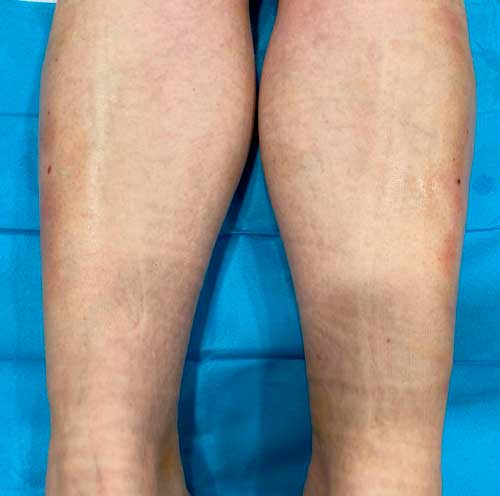 Fasciotomía del síndrome compartimental. Cicatrices (los puntos rojos) Fasciotomía del síndrome compartimental. Cicatrices (los puntos rojos) de cirugía ecoguiada ultramínimamente invasiva. En este caso, síndrome compartimental de esfuerzo en deportista en el compartimento anterior y lateral de la pierna.