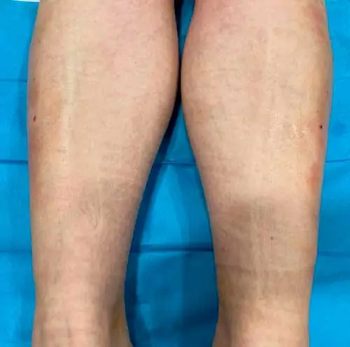 Fasciotomía del síndrome compartimental. Cicatrices (los puntos rojos) Fasciotomía del síndrome compartimental. Cicatrices (los puntos rojos) de cirugía ecoguiada ultramínimamente invasiva. En este caso, síndrome compartimental de esfuerzo en deportista en el compartimento anterior y lateral de la pierna.