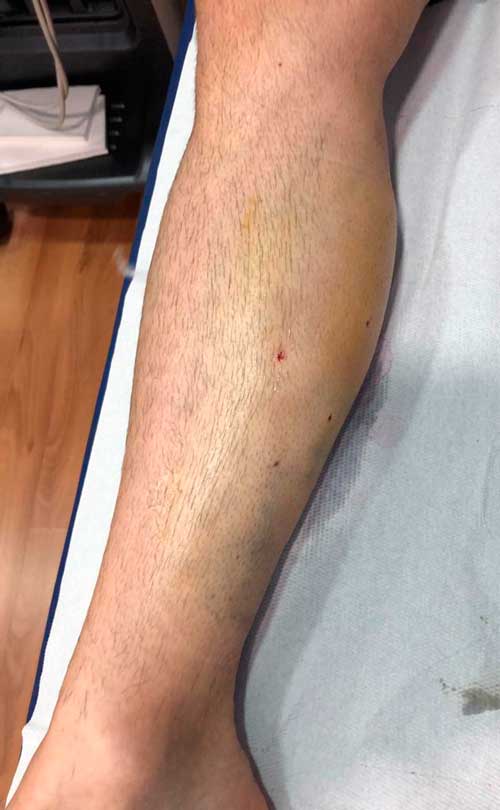 Fasciotomía del síndrome compartimental Fasciotomía del síndrome compartimental. Cicatrices (los puntos rojos) de cirugía ecoguiada ultramínimamente invasiva por síndrome compartimental de esfuerzo en deportista en el compartimento posterior, gemelos y soleo.