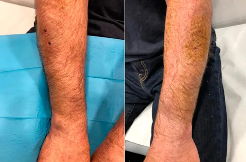 Fasciotomía ecoguiada del compartimento dorsal del antebrazo Fasciotomía ecoguiada del compartimento dorsal del antebrazo