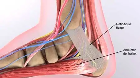 Retináculo síndrome del túnel del tarso Neuropatía o Compresión del túnel del tarso