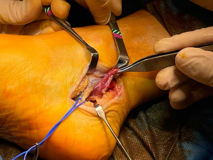 Extirpación con cirugía abierta del músculo accesorio que comprimía el nervio tibial Extirpación con cirugía abierta del músculo accesorio que comprimía el nervio tibial