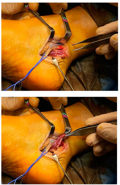Results of ultrasound-guided release of tarsal tunnel syndrome: a review of 81 cases with a minimum follow-up of 18 months Results of ultrasound-guided release of<br />tarsal tunnel syndrome: a review of 81<br />cases with a minimum follow-up of 18<br />months
