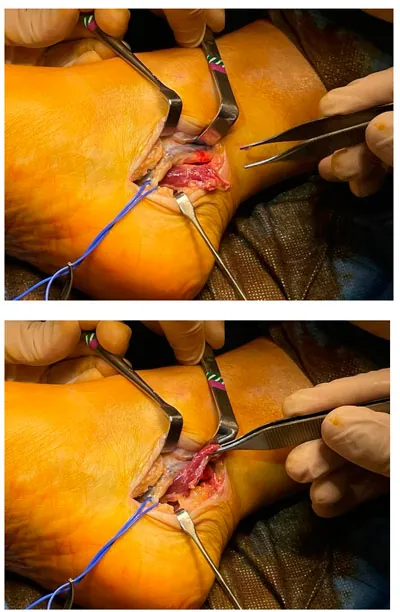 Results of ultrasound-guided release of tarsal tunnel syndrome: a review of 81 cases with a minimum follow-up of 18 months Results of ultrasound-guided release of<br />tarsal tunnel syndrome: a review of 81<br />cases with a minimum follow-up of 18<br />months